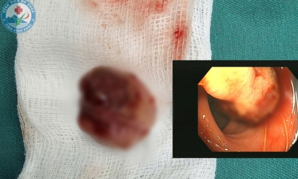 Nam sinh lớp 9 nặng 27kg khiến bác sĩ kinh ngạc vì sức chịu đựng khi bị chảy máu kéo dài suốt 1 năm