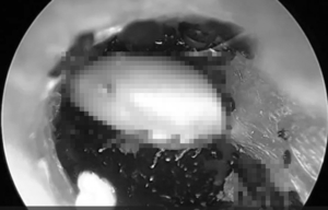 Nghe tiếng động lạ trong tai, cậu bé 8 tuổi đi khám, bác sĩ phát hoảng khi thấy 'quỷ 8 chân' bên trong