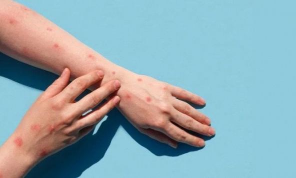 WHO duy trì cảnh báo cao nhất về dịch đậu mùa khỉ