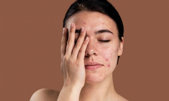 Mẹo chăm sóc da nhạy cảm khỏe mạnh hơn mùa hanh khô