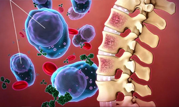 Nghiên cứu hé lộ một chế độ ăn làm chậm tiến trình của chứng ung thư khó chữa