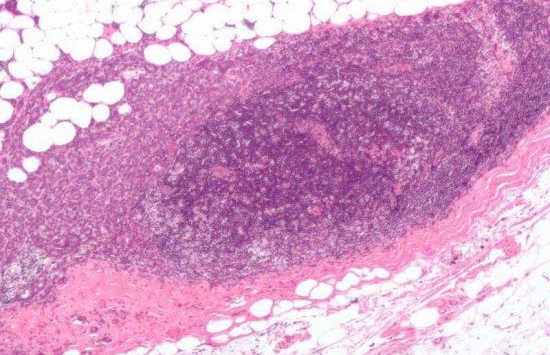 AI nâng cao khả năng phát hiện ung thư vú, mở ra hy vọng mới cho phụ nữ