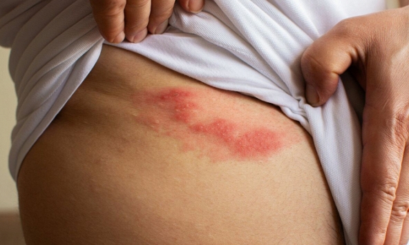 Cụ bà 72 tuổi gặp biến chứng nghiêm trọng vì bôi dầu nóng khi bị Zona