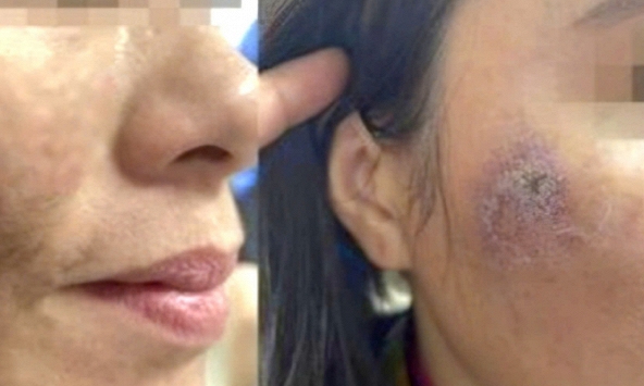 Người phụ nữ bị bỏng toàn bộ khuôn mặt vì điều trị nám ở spa để đón Tết