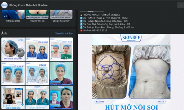 Lý do phòng khám Phẫu thuật Thẩm mỹ Skinbee bị xử phạt và đình chỉ hoạt động?