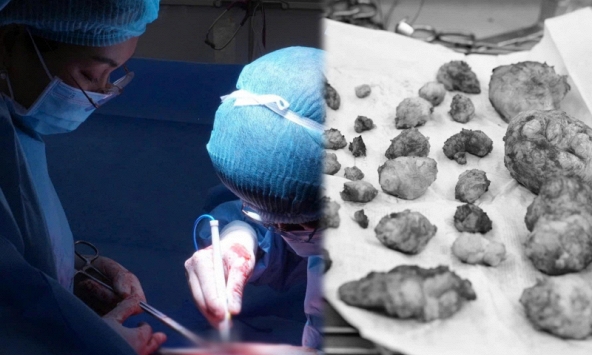 Không phải 10 mà có đến 28 khối u xơ trong tử cung: Hành trình 4 tiếng giữ lại cơ hội làm mẹ cho người phụ nữ 38 tuổi