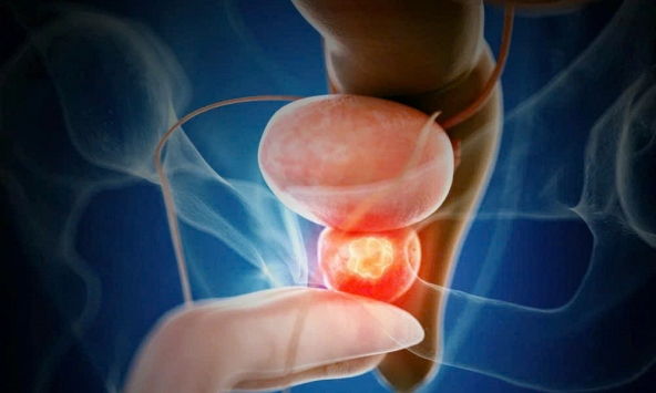 Phát hiện mới: Xét nghiệm ung thư tiền liệt tuyến sớm chưa hẳn đã là tốt