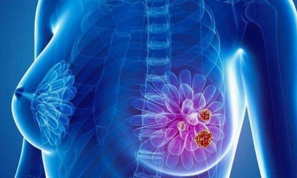 Đột phá về công nghệ nano nhân lên hy vọng điều trị ung thư vú ác tính