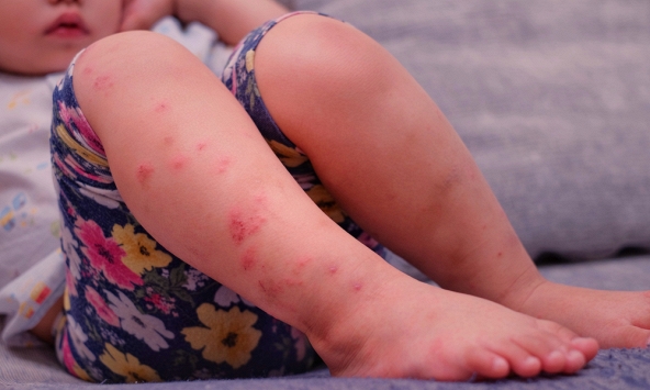 Hà Nội ghi nhận 5 ổ dịch tay chân miệng tại các quận, huyện trong một tuần