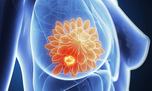 AstraZeneca công bố bước tiến đột phá trong điều trị ung thư vú