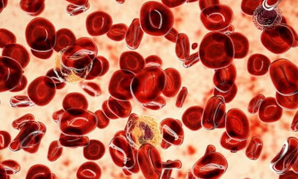 Xét nghiệm máu đột phá giúp phát hiện nguy cơ bệnh bạch cầu