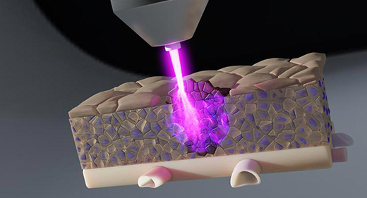 Tia plasma lạnh, 'vũ khí mới' trong điều trị ung thư: diệt khối u ẩn, giảm nguy cơ tái phát