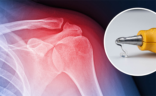 “Súng bắn keo 3D” giúp tái tạo xương ngay trong ca phẫu thuật