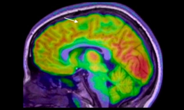 AI giúp nhận diện tổn thương não siêu nhỏ, tăng cơ hội điều trị động kinh ở trẻ em