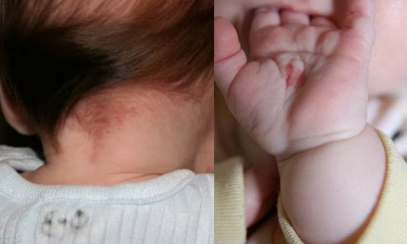 Em bé có bớt đỏ trên người: Dấu hiệu cho thấy con sinh ra với một “vết son” đặc biệt