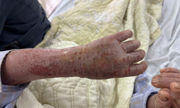 Người phụ nữ bị ngứa dữ dội đến mức “ảo giác có sâu bò”: Nguyên nhân gây sốc từ thói quen nhiều người Việt vẫn làm