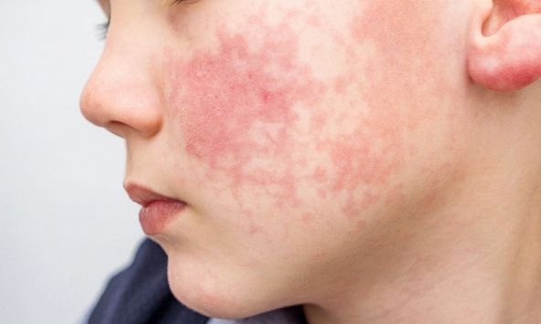 8 dấu hiệu ban đầu của 'căn bệnh dễ lây lan nhất thế giới': Xuất hiện TRƯỚC cả khi phát ban, trẻ dưới 5 tuổi có nguy cơ cao nhất