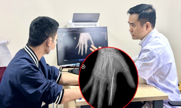 Lần đầu tiên tại Việt Nam: Nối thành công ngón tay bị đứt rời sau 25 giờ thiếu máu cho một thủy thủ 