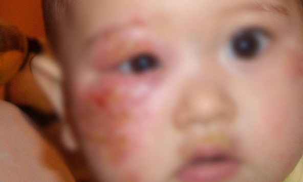 Bé gái 4 tuổi mắc giang mai - nguồn lây không ngờ từ một thói quen cho cháu ăn của bà nội