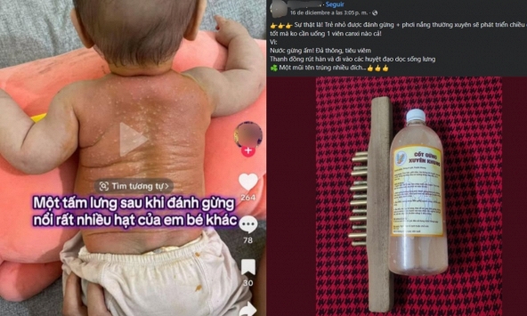 Hội mẹ bỉm hoang mang với trường phái 'đánh gừng xuyên khung': Đánh gừng trị bách bệnh từ ốm sốt đến tăng chiều cao?