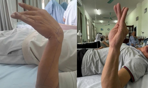 Ngủ gật 30 phút trong giờ làm, người đàn ông 37 tuổi bỗng liệt dây thần kinh, không nhấc nổi cổ tay