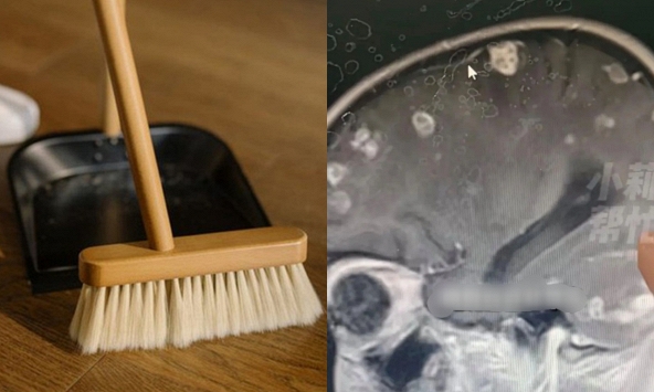 Cảnh giác khi “tổng vệ sinh” trước Tết: Bé gái 6 tuổi sốt 17 ngày liền, não xuất hiện hơn 20 ổ tổn thương