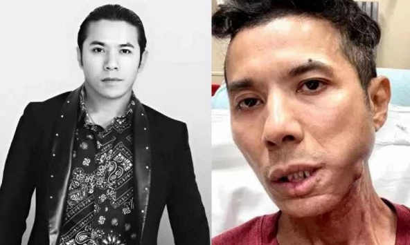 Ca sĩ Kasim Hoàng Vũ qua đời ở tuổi 46: Căn bệnh xương hàm khiến gương mặt biến dạng và cuộc chiến kéo dài nhiều năm