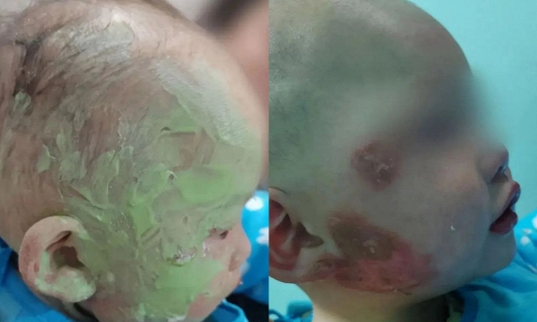 Bé 1 tuổi bị bỏng mặt, gia đình bôi đầy kem đánh răng theo “mẹo dân gian”: Bác sĩ cảnh báo có thể gây nhiễm trùng nặng