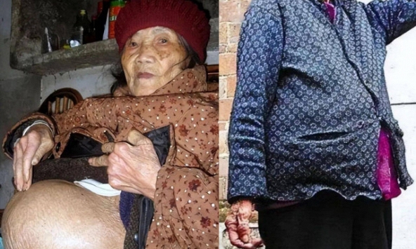 Cụ bà 91 tuổi ngã khi đi lấy nước, vào viện thì phát hiện “mang thai”: Bí mật về 'bào thai hoá đá'