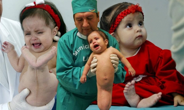 Nàng tiên cá ngoài đời thực: Bé gái chào đời với đôi chân dính liền và 15 sống năm phi thường như 'một kỳ tích y học'