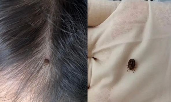 Bé 1 tuổi bị ve chui vào da đầu, bác sĩ cảnh báo: Tuyệt đối không tự ý giật ra