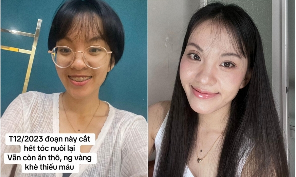Màn thay đổi 'đáng đồng tiền' của cô gái TP.HCM sau khi từ bỏ ăn thô, niềng răng và mổ mắt cận
