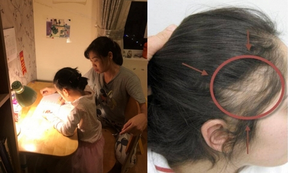 Thức khuya kèm con học, mẹ rụng tóc đến hói cả đầu!
