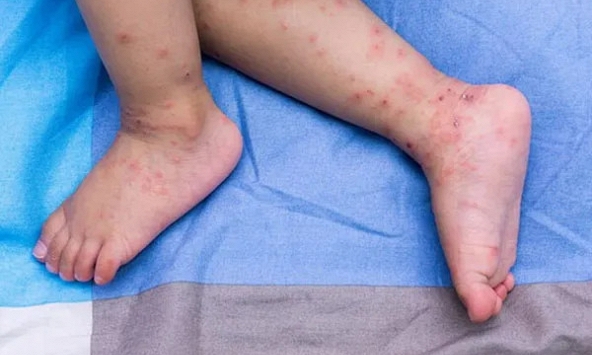 Bệnh tay chân miệng tăng mạnh, bác sĩ lưu ý 6 dấu hiệu cảnh báo bệnh diễn tiến nặng, cần đưa trẻ đến viện ngay
