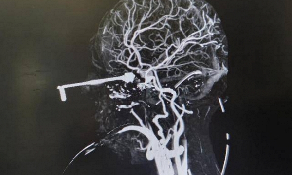 Bé 3 tuổi bị kim móc đâm xuyên não, bác sĩ nhấn mạnh “3 nguyên tắc sơ cứu” cha mẹ tuyệt đối phải nhớ