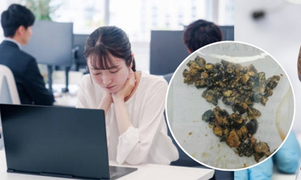 Nữ nhân viên văn phòng 35 tuổi cấp cứu vì đau bụng dữ dội, bác sĩ phát hiện túi mật vỡ, rơi ra 60 viên...