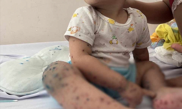 Virus mới khiến trẻ mắc tay chân miệng chuyển nặng, tử vong rất nhanh là gì? Làm cách nào để phòng tránh?