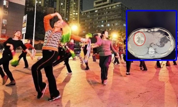 Người phụ nữ 70 tuổi vỡ khối u gan vì nhảy múa 'quá mức'