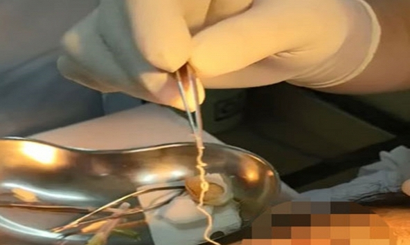 “Bất ngờ” với chàng trai 24 tuổi nhưng 13 năm bị sinh vật sống 'gậm nhấm' não, gây tàn tật: Khi gắp ra ngoài còn ngoe nguẩy