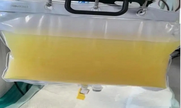 Rút ra 2 lít máu trắng đục như sữa từ cô bé 12 tuổi, bố mẹ oà khóc: 'Tưởng cháu đau bụng vì ăn đồ không sạch'