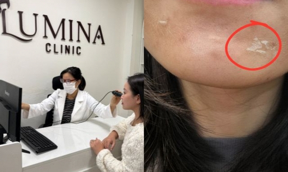 Peel da không phải “cứ làm là đẹp”: Chuyên gia cảnh báo 4 sai lầm khiến da càng ngày càng tệ