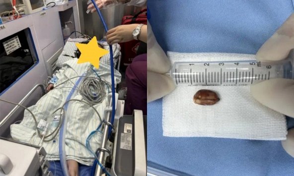 Bé 2 tuổi ăn đậu phộng suýt mất mạng, tim ngừng đập khi đến viện