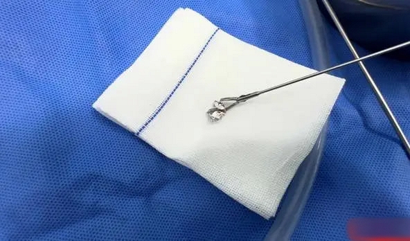 Bé 8 tháng tuổi bị “mắc dị vật ở họng” do nuốt phải giấy bạc: Nguy cơ tử vong cao mà nhiều phụ huynh dễ chủ quan