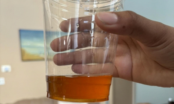 Ngày càng có nhiều người tử vong vì ung thư tuyến tụy, bác sĩ nhắc: Đừng xem nhẹ 3 thứ khi đi vệ sinh!