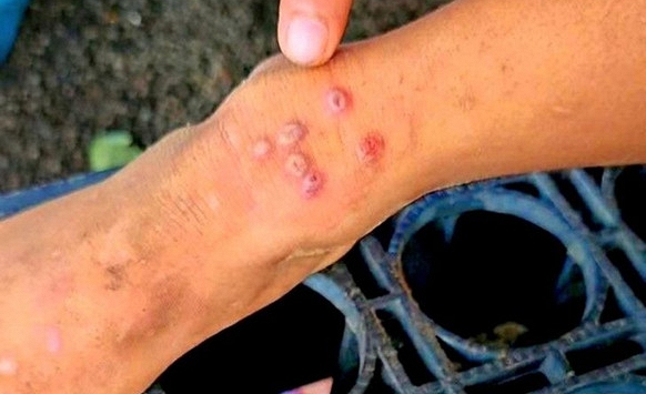 Thái Lan bật cảnh báo khi 23 người tử vong, 732 người bị lây nhiễm 1 căn bệnh, ở Việt Nam cũng đã xuất hiện