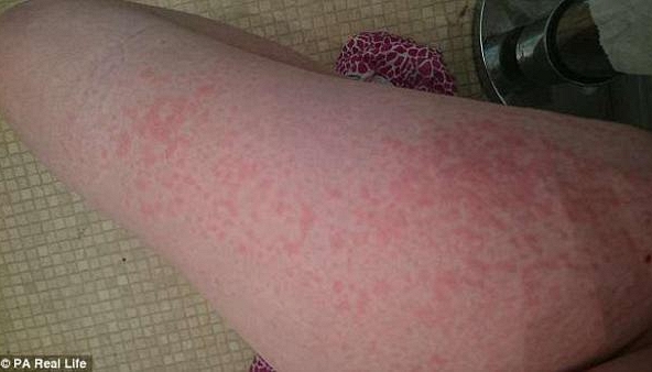 Những cơn 'ngứa khó nói' khi mang thai, còn ám ảnh hơn cả ốm nghén