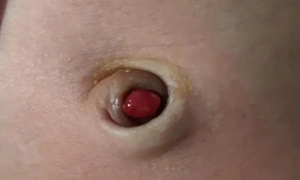 Bé sơ sinh mọc “cục thịt nhỏ” ở rốn, còn rỉ dịch: Đây không phải viêm rốn thông thường