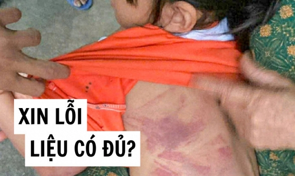 Tôi bàng hoàng khi xem bức ảnh bé gái Tiểu học bị bạn nam cùng lớp đánh bầm lưng: Hỏi thật, một lời xin lỗi liệu có đủ?