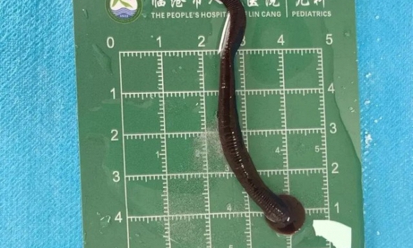 Rùng mình: Bé 8 tuổi ở Trung Quốc được lấy ra con đỉa sống dài 8cm trong khí quản, trước đó từng lấy ra 1 con  từ mũi