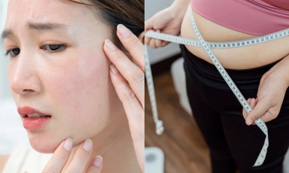 Không phải do bạn lười tập: Đây mới là lý do khiến nhiều người không thể 'đốt mỡ', càng giảm cân càng thấy mụn